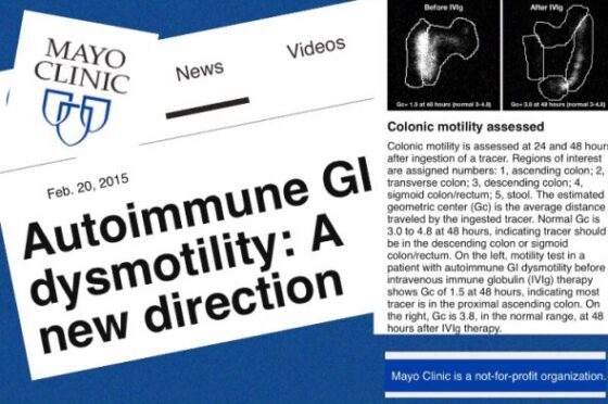 Dismotilità Gastrointestinale Autoimmune: una nuova direzione, dal 2015. Trattabile con IVIG.